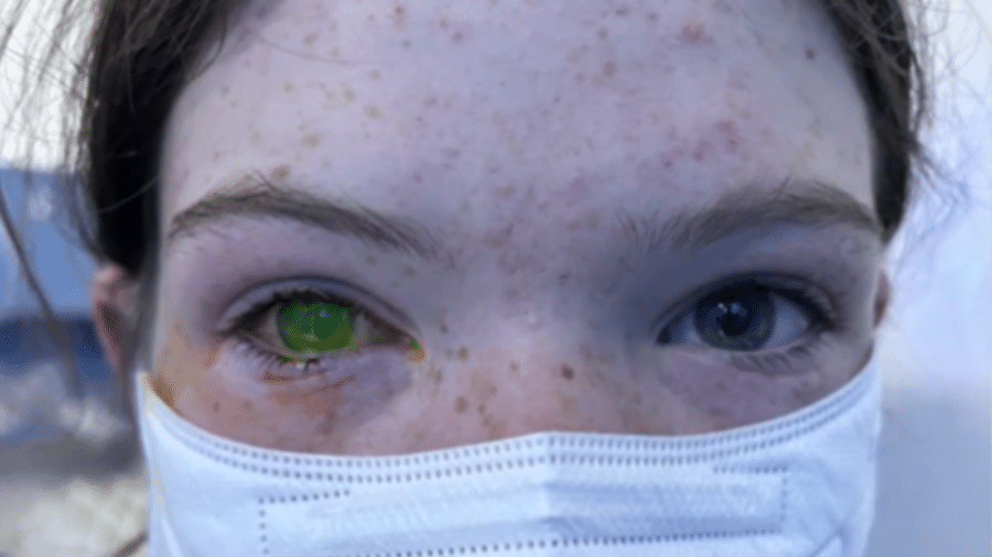 Doença dos “Olhos Esverdeados” na Austrália assusta médicos