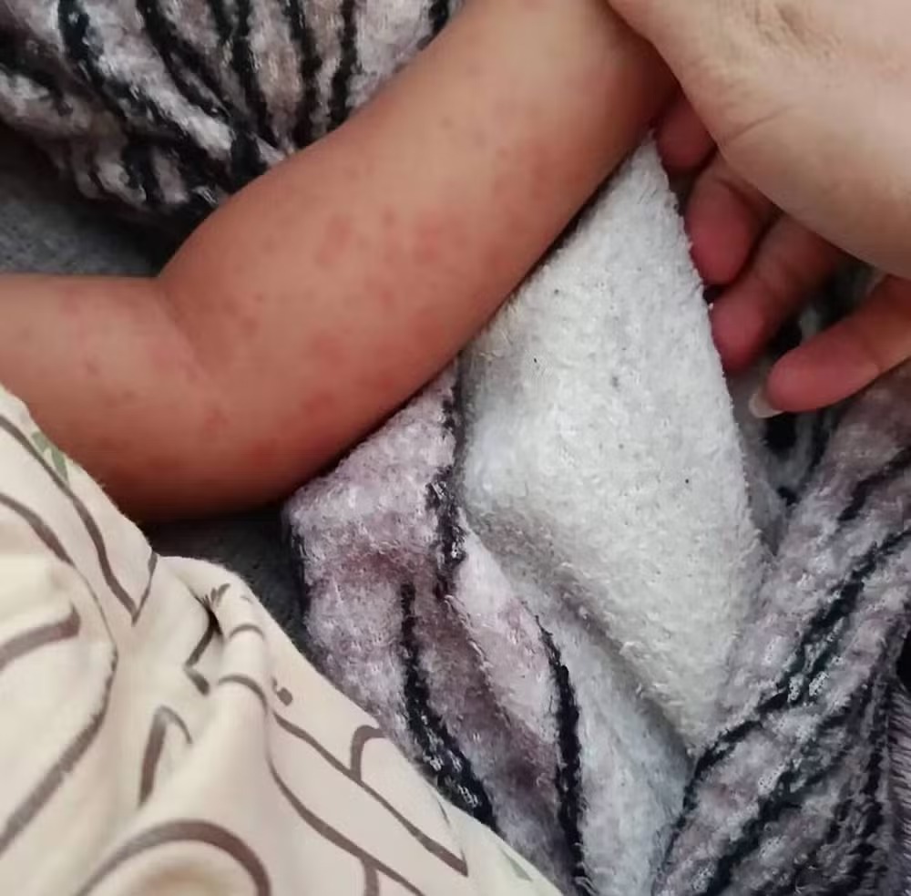 Menino de 2 anos morre com suspeita de febre maculosa em Três Rios